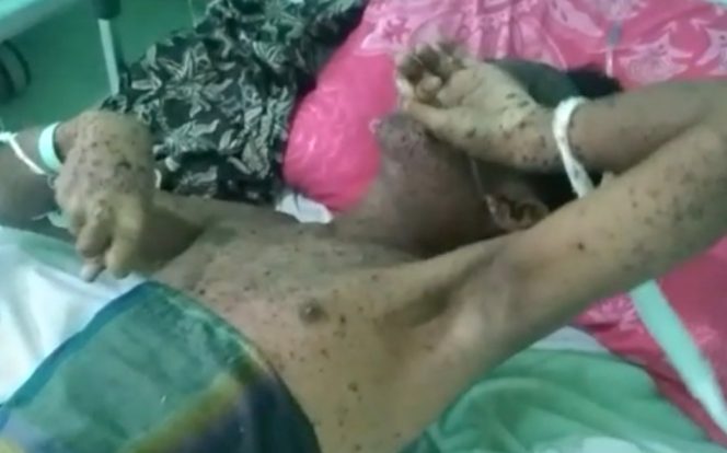 
					Pasien yang dirawat di RSUD Meranti.