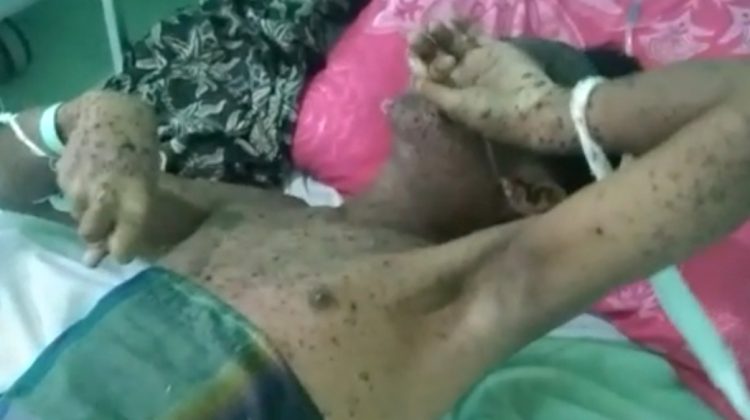 Pasien yang dirawat di RSUD Meranti.